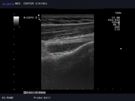 Ultrazvok rame - peritendinitis tetive m. biceps brachii